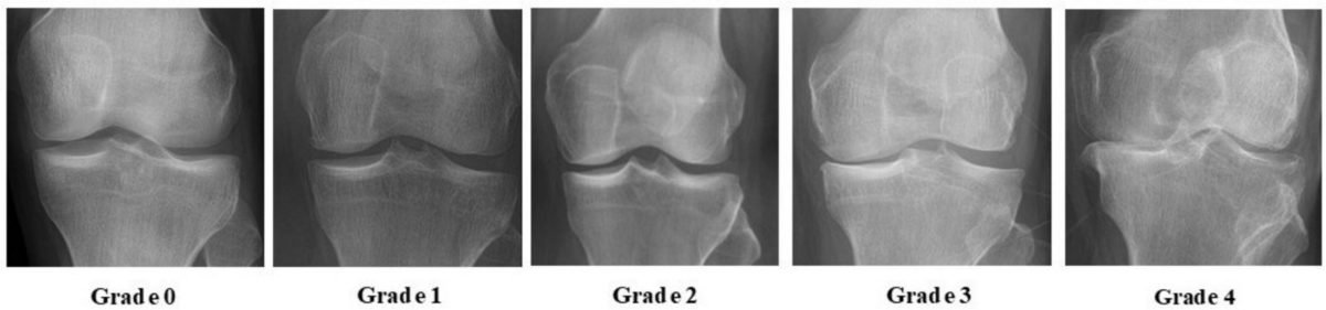 ग्रेड 0 से 4 तक घुटने के X-ray में जोड़ की जगह कम होना